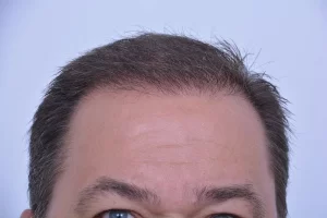 mens-before-and-after-patient-3-b mens-before-and-after-patient-3-b