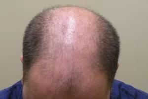 mens-before-and-after-patient-3-c mens-before-and-after-patient-3-c