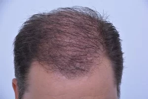 mens-before-and-after-patient-3-d mens-before-and-after-patient-3-d