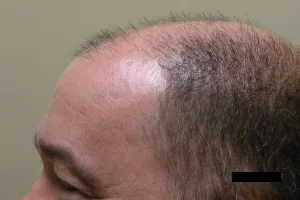 mens-before-and-after-patient-3-e mens-before-and-after-patient-3-e