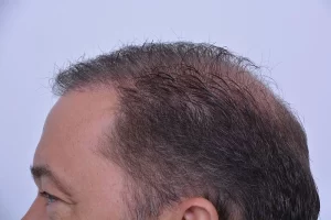 mens-before-and-after-patient-3-f mens-before-and-after-patient-3-f