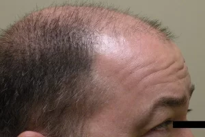 mens-before-and-after-patient-3-g mens-before-and-after-patient-3-g