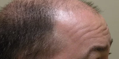mens-before-and-after-patient-3-g mens-before-and-after-patient-3-g