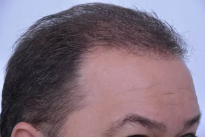 mens-before-and-after-patient-3-h mens-before-and-after-patient-3-h