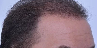 mens-before-and-after-patient-3-h mens-before-and-after-patient-3-h