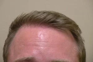 mens-before-and-after-patient-30-b mens-before-and-after-patient-30-b