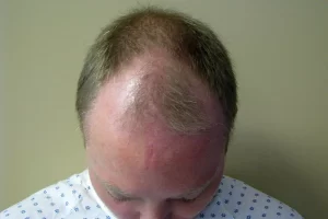 mens-before-and-after-patient-30-c mens-before-and-after-patient-30-c