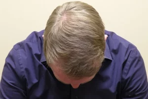 mens-before-and-after-patient-30-d mens-before-and-after-patient-30-d