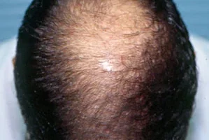 mens-before-and-after-patient-31-a mens-before-and-after-patient-31-a
