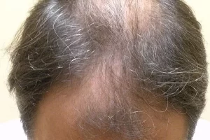 mens-before-and-after-patient-4-a mens-before-and-after-patient-4-a