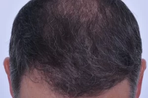mens-before-and-after-patient-4-b mens-before-and-after-patient-4-b