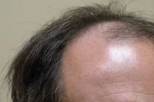 mens-before-and-after-patient-4-c mens-before-and-after-patient-4-c