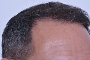 mens-before-and-after-patient-4-d mens-before-and-after-patient-4-d