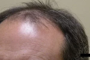 mens-before-and-after-patient-4-e mens-before-and-after-patient-4-e