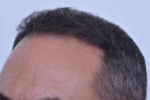 mens-before-and-after-patient-4-f mens-before-and-after-patient-4-f