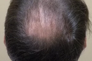 mens-before-and-after-patient-4-g mens-before-and-after-patient-4-g