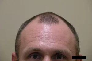 mens-before-and-after-patient-5-a mens-before-and-after-patient-5-a