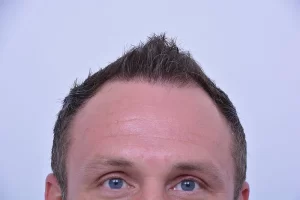 mens-before-and-after-patient-5-b mens-before-and-after-patient-5-b