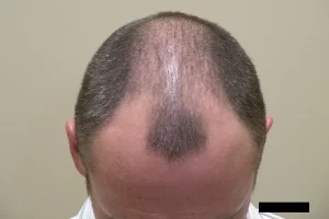 mens-before-and-after-patient-5-c mens-before-and-after-patient-5-c