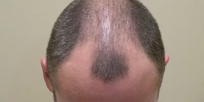 mens-before-and-after-patient-5-c mens-before-and-after-patient-5-c