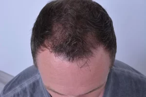 mens-before-and-after-patient-5-d mens-before-and-after-patient-5-d