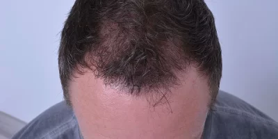 mens-before-and-after-patient-5-d mens-before-and-after-patient-5-d