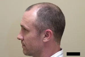 mens-before-and-after-patient-5-e mens-before-and-after-patient-5-e