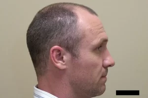 mens-before-and-after-patient-5-g mens-before-and-after-patient-5-g