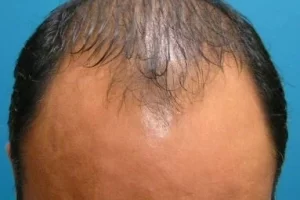 mens-before-and-after-patient-6-a mens-before-and-after-patient-6-a