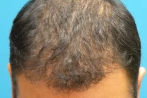 mens-before-and-after-patient-6-b mens-before-and-after-patient-6-b