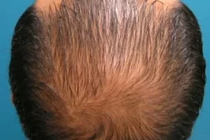 mens-before-and-after-patient-6-c mens-before-and-after-patient-6-c