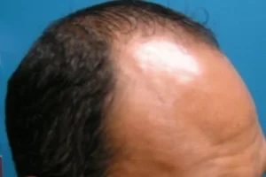 mens-before-and-after-patient-6-e mens-before-and-after-patient-6-e