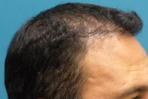 mens-before-and-after-patient-6-f mens-before-and-after-patient-6-f