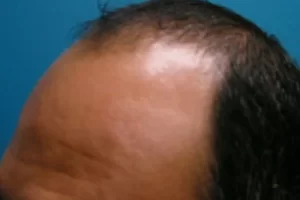 mens-before-and-after-patient-6-g mens-before-and-after-patient-6-g