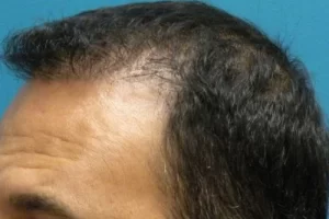 mens-before-and-after-patient-6-h mens-before-and-after-patient-6-h