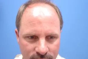 mens-before-and-after-patient-7-a mens-before-and-after-patient-7-a