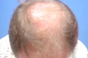 mens-before-and-after-patient-7-c mens-before-and-after-patient-7-c