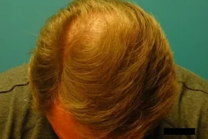 mens-before-and-after-patient-7-d mens-before-and-after-patient-7-d