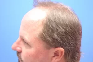 mens-before-and-after-patient-7-e mens-before-and-after-patient-7-e