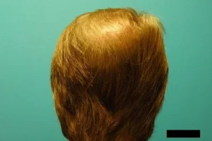 mens-before-and-after-patient-7-h mens-before-and-after-patient-7-h