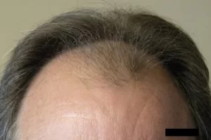mens-before-and-after-patient-8-a mens-before-and-after-patient-8-a