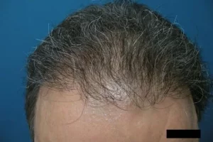 mens-before-and-after-patient-8-b mens-before-and-after-patient-8-b
