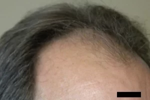 mens-before-and-after-patient-8-c mens-before-and-after-patient-8-c