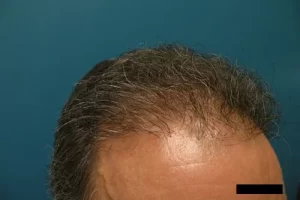 mens-before-and-after-patient-8-d mens-before-and-after-patient-8-d