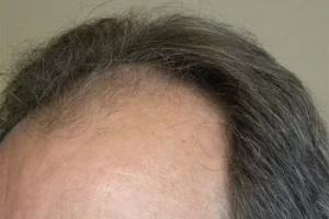 mens-before-and-after-patient-8-e mens-before-and-after-patient-8-e