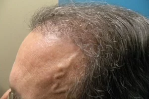 mens-before-and-after-patient-8-f mens-before-and-after-patient-8-f