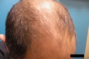 mens-before-and-after-patient-9-c mens-before-and-after-patient-9-c