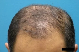 mens-before-and-after-patient-9-d mens-before-and-after-patient-9-d