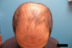 mens-before-and-after-patient-9-e mens-before-and-after-patient-9-e