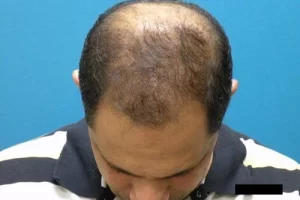mens-before-and-after-patient-9-f mens-before-and-after-patient-9-f